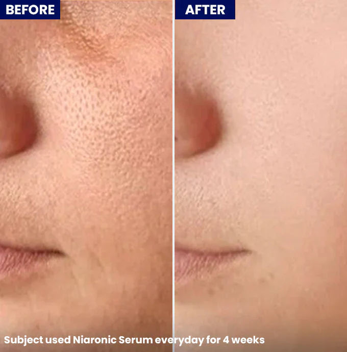 Jenpharm Niaronic Acne Control Serum Vitamin B3 30Ml before after skin results