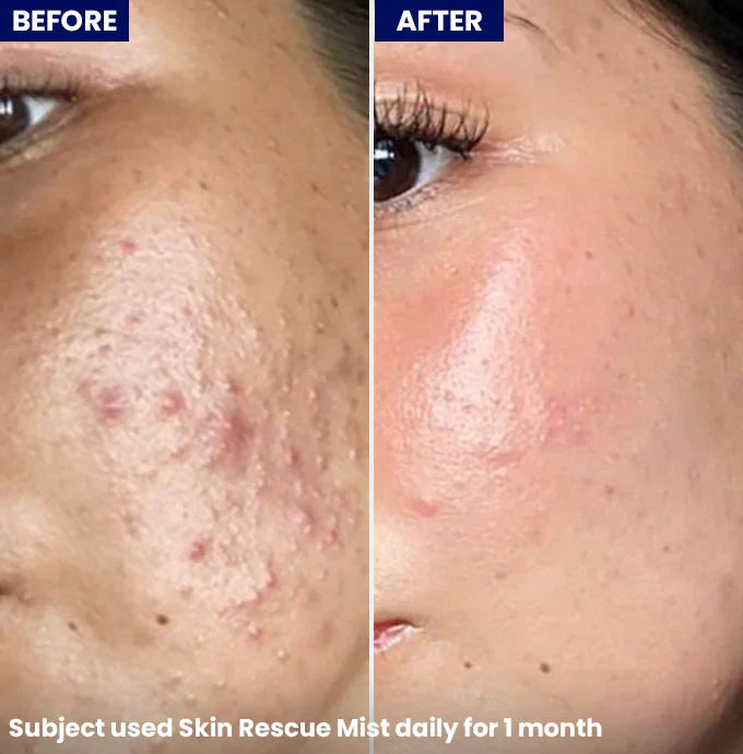Jenpharm - Skin Rescue Mist before after skin results